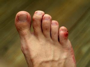 how long does a stubbed toe take to heal